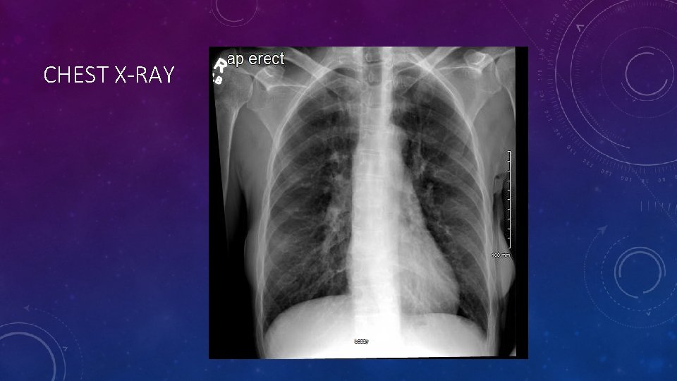 CHEST X-RAY 