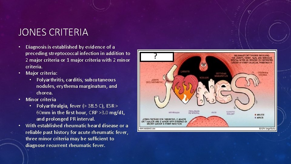 JONES CRITERIA • Diagnosis is established by evidence of a preceding streptococcal infection in
