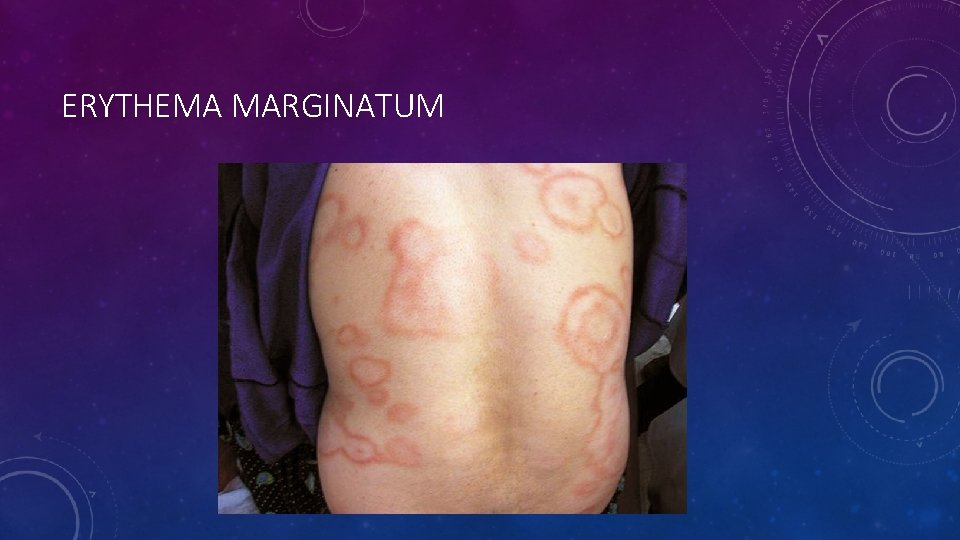 ERYTHEMA MARGINATUM 