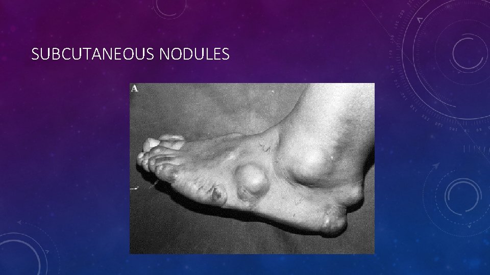 SUBCUTANEOUS NODULES 