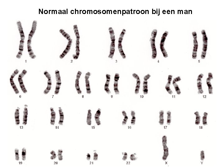 Normaal chromosomenpatroon bij een man 