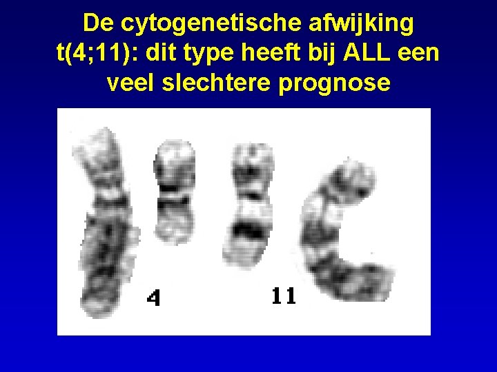 De cytogenetische afwijking t(4; 11): dit type heeft bij ALL een veel slechtere prognose