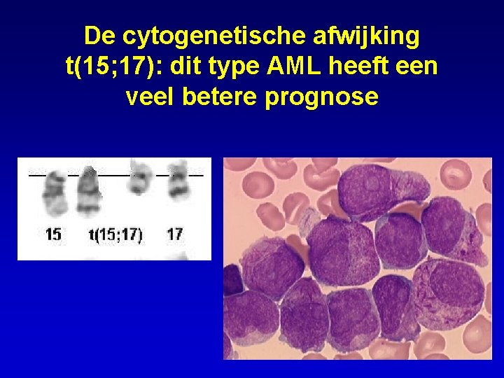 De cytogenetische afwijking t(15; 17): dit type AML heeft een veel betere prognose 