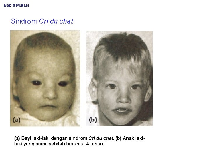 Bab 6 Mutasi Sindrom Cri du chat (a) Bayi laki-laki dengan sindrom Cri du