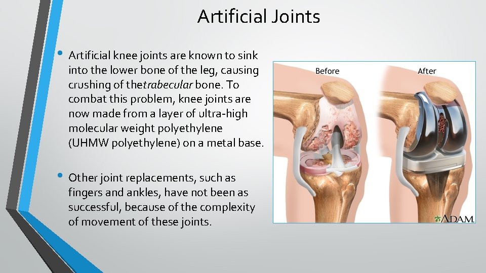 Artificial Joints • Artificial knee joints are known to sink into the lower bone