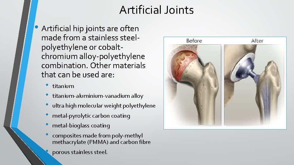 Artificial Joints • Artificial hip joints are often made from a stainless steelpolyethylene or