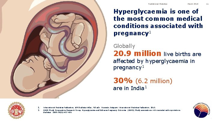 Gestational Diabetes March 2016 Hyperglycaemia is one of the most common medical conditions associated