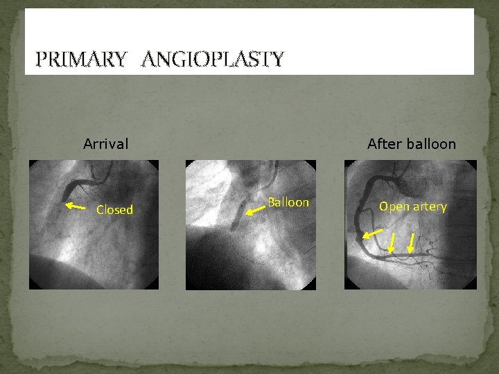 PRIMARY ANGIOPLASTY Arrival Closed After balloon Balloon Open artery 