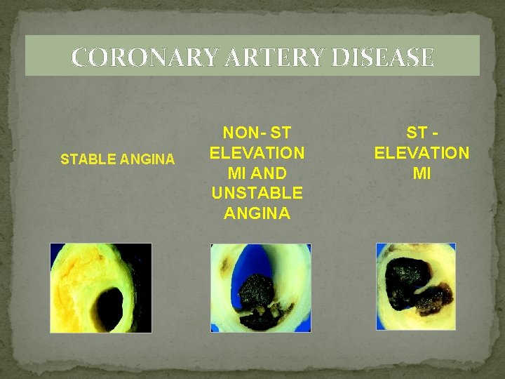 CORONARY ARTERY DISEASE STABLE ANGINA NON- ST ELEVATION MI AND UNSTABLE ANGINA ST ELEVATION