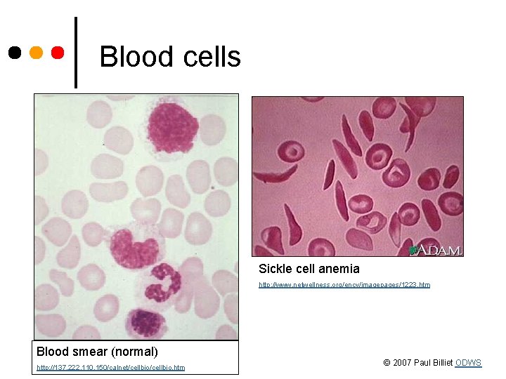 Blood cells Sickle cell anemia http: //www. netwellness. org/ency/imagepages/1223. htm Blood smear (normal) http: