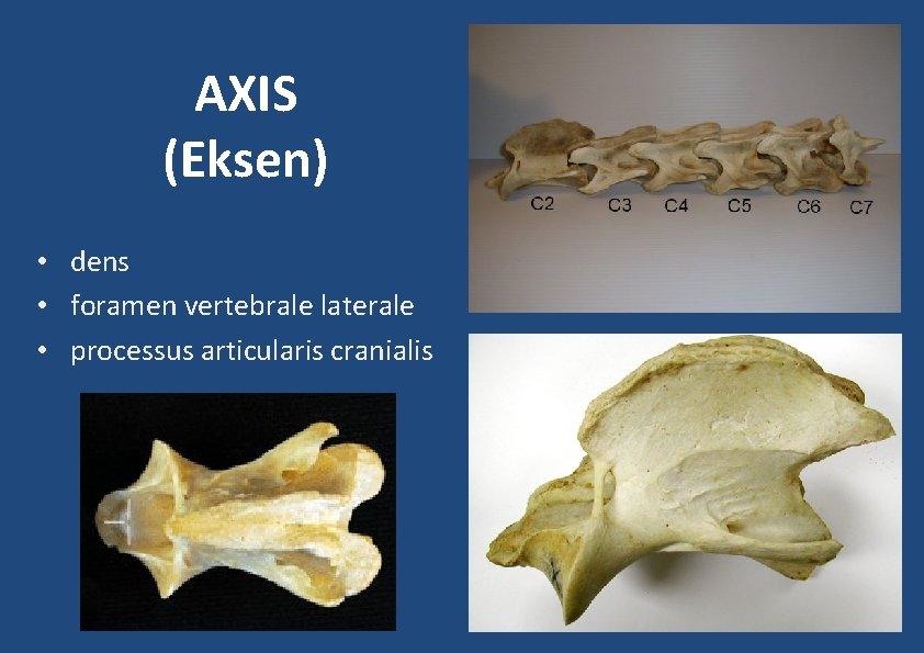 AXIS (Eksen) • dens • foramen vertebrale laterale • processus articularis cranialis AXIS (Eksen) • dens • foramen vertebrale laterale • processus articularis cranialis