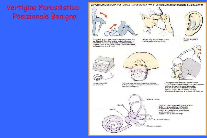 Vertigine Parossistica Posizionale Benigna 