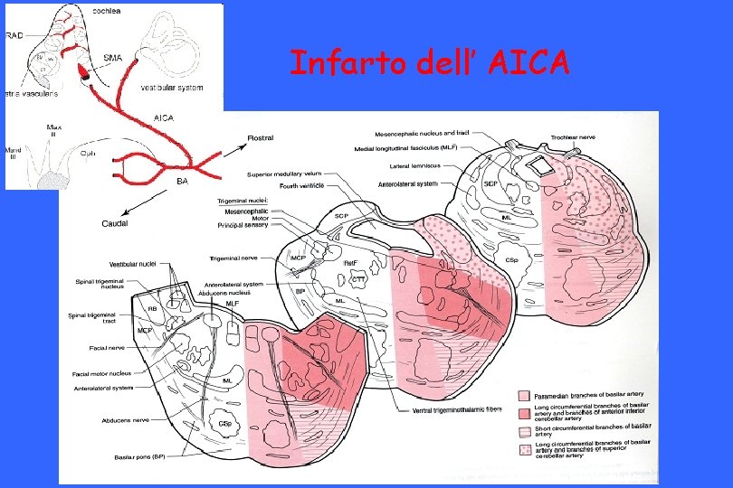 Infarto dell’ AICA 