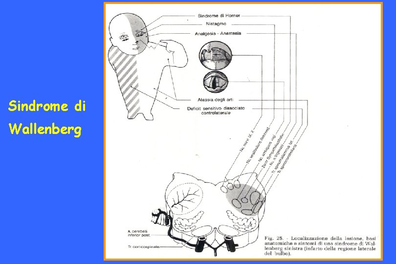 Sindrome di Wallenberg 