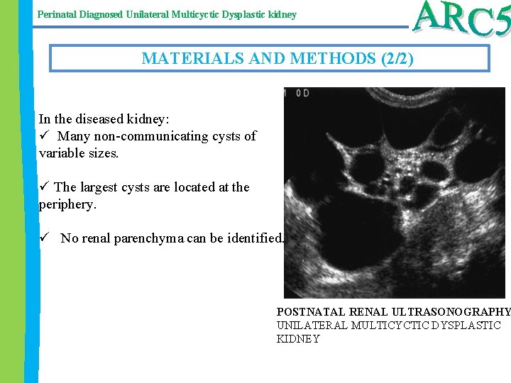 Perinatal Diagnosed Unilateral Multicyctic Dysplastic kidney MATERIALS AND METHODS (2/2) In the diseased kidney: