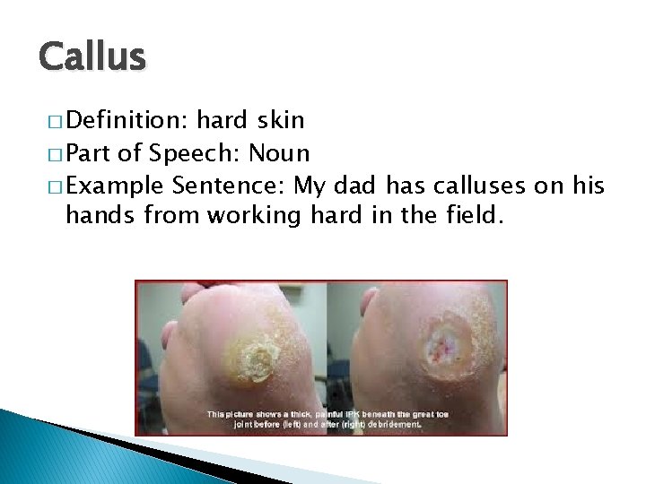 Callus � Definition: hard skin � Part of Speech: Noun � Example Sentence: My