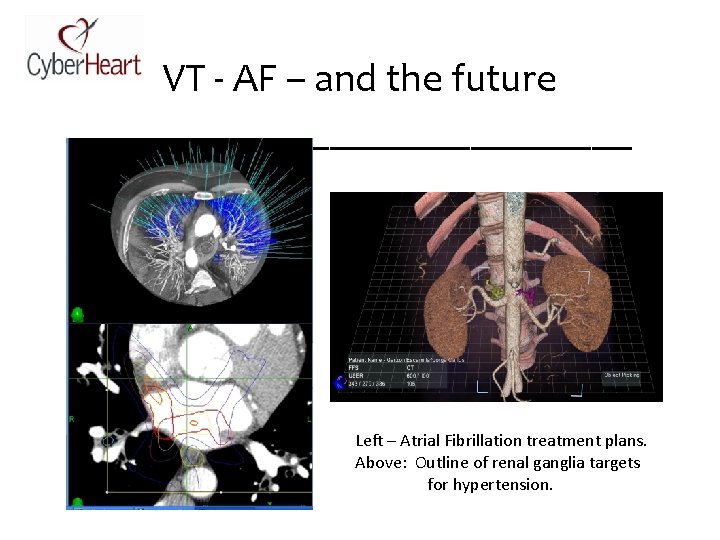 VT - AF – and the future ______________ ure Left – Atrial Fibrillation treatment