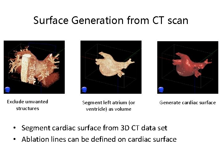 Surface Generation from CT scan Exclude unwanted structures Segment left atrium (or ventricle) as
