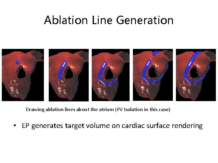 Ablation Line Generation Drawing ablation lines about the atrium (PV Isolation in this case)