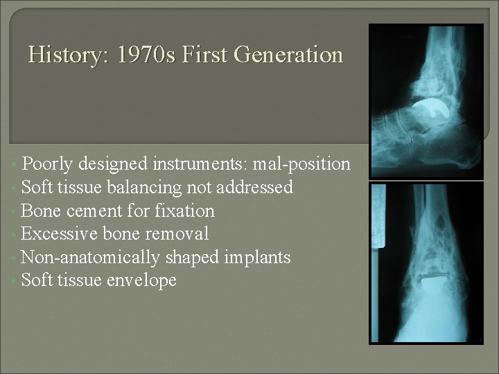 History: 1970 s First Generation Poorly designed instruments: mal-position • Soft tissue balancing not