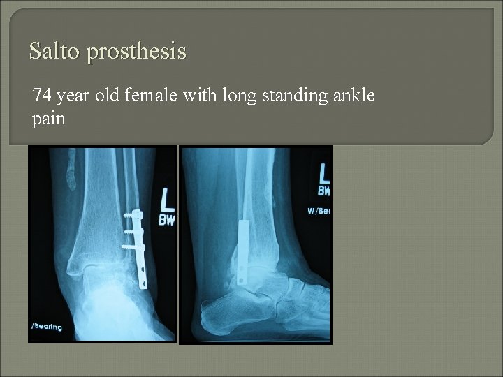 Salto prosthesis 74 year old female with long standing ankle pain 