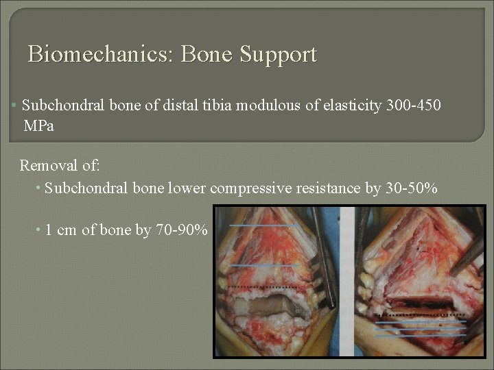 Biomechanics: Bone Support • Subchondral bone of distal tibia modulous of elasticity 300 -450