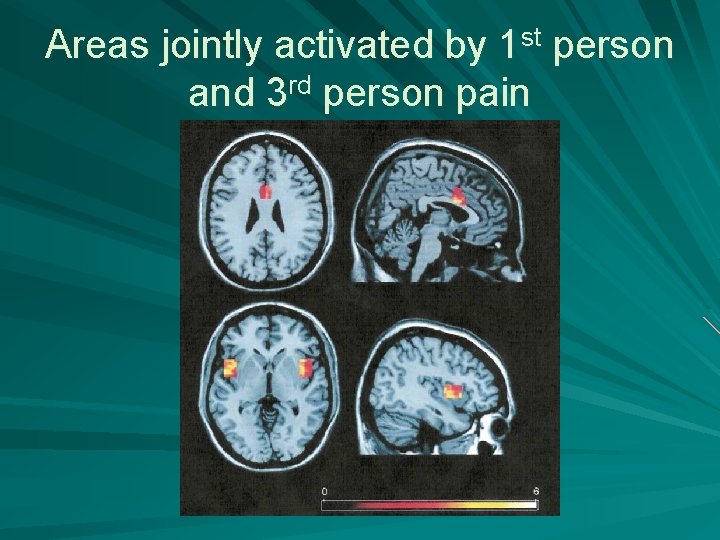 Areas jointly activated by 1 st person and 3 rd person pain 