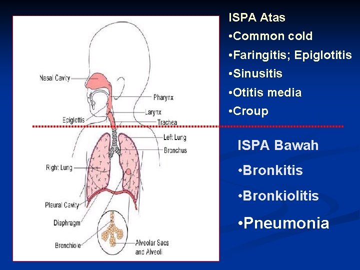 ISPA Atas • Common cold • Faringitis; Epiglotitis • Sinusitis • Otitis media •