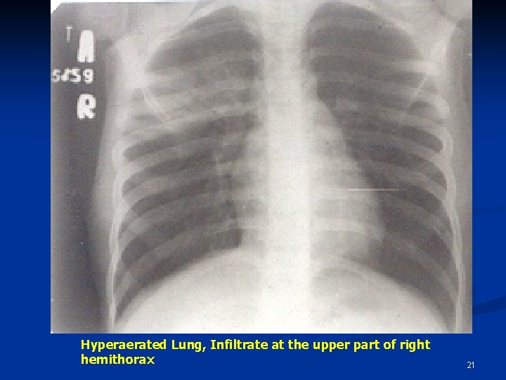 Hyperaerated Lung, Infiltrate at the upper part of right hemithorax 21 