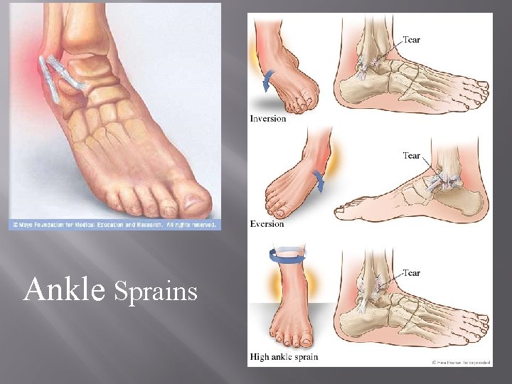 Ankle Sprains 