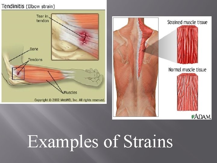 Examples of Strains 