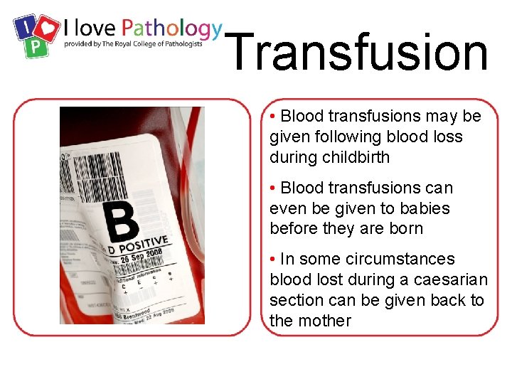 Transfusion • Blood transfusions may be given following blood loss during childbirth • Blood