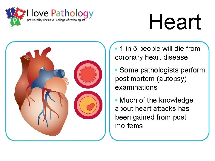 Heart • 1 in 5 people will die from coronary heart disease • Some