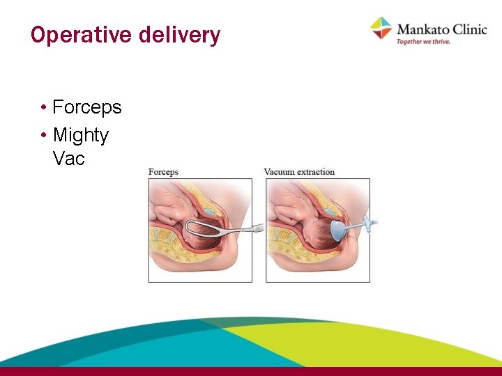 Operative delivery • Forceps • Mighty Vac 