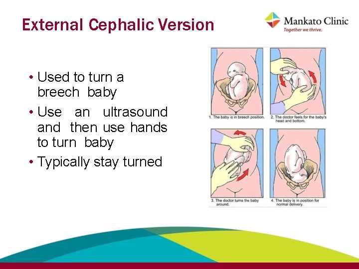 External Cephalic Version • Used to turn a breech baby • Use an ultrasound