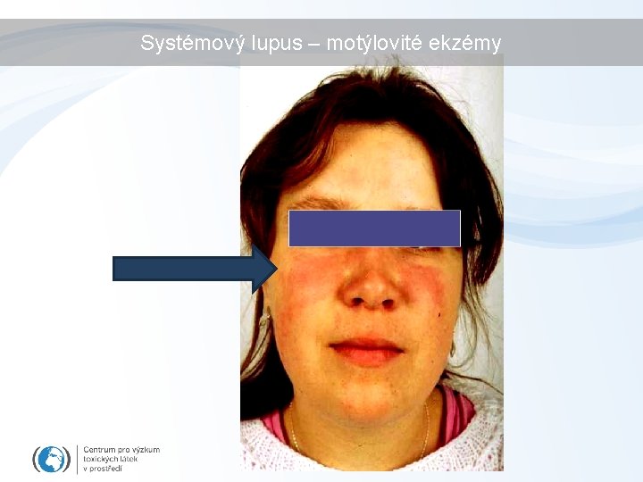 Systémový lupus – motýlovité ekzémy 