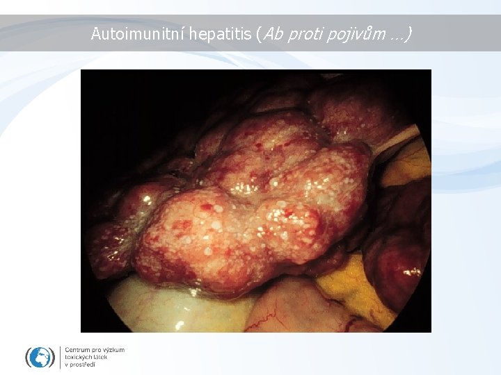 Autoimunitní hepatitis (Ab proti pojivům …) 