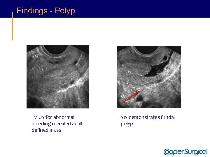 Findings - Polyp TV US for abnormal bleeding revealed an illdefined mass SIS demonstrates