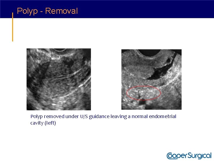 Polyp - Removal Polyp removed under U/S guidance leaving a normal endometrial cavity (left)