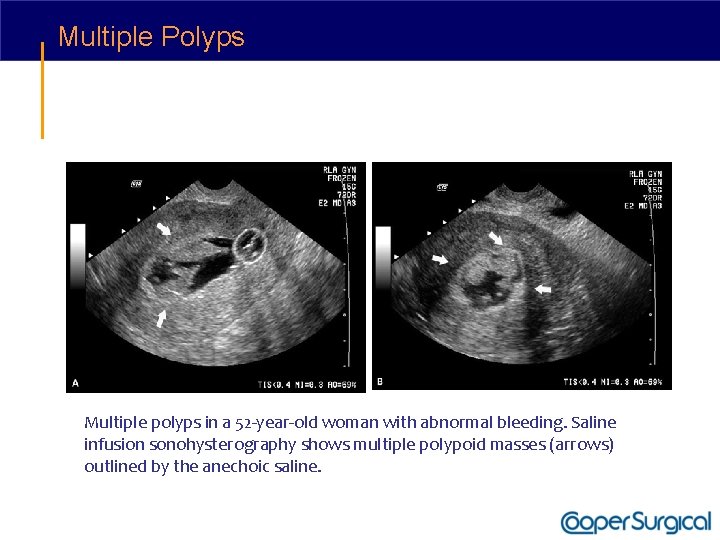 Multiple Polyps Multiple polyps in a 52 -year-old woman with abnormal bleeding. Saline infusion