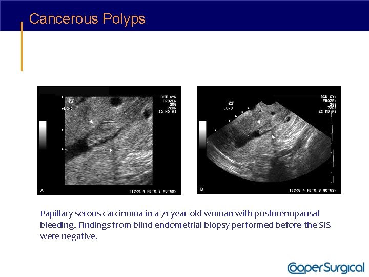 Cancerous Polyps Papillary serous carcinoma in a 71 -year-old woman with postmenopausal bleeding. Findings