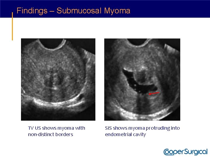 Findings – Submucosal Myoma TV US shows myoma with non-distinct borders SIS shows myoma