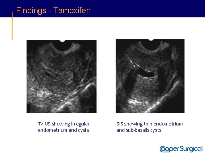Findings - Tamoxifen TV US showing irregular endometrium and cysts SIS showing thin endometrium
