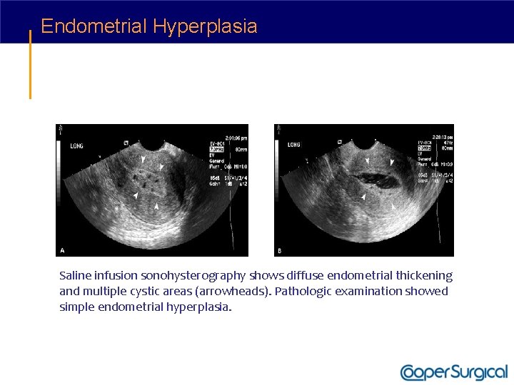 Endometrial Hyperplasia Saline infusion sonohysterography shows diffuse endometrial thickening and multiple cystic areas (arrowheads).