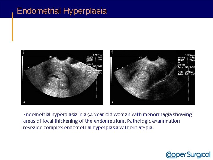 Endometrial Hyperplasia Endometrial hyperplasia in a 54 -year-old woman with menorrhagia showing areas of