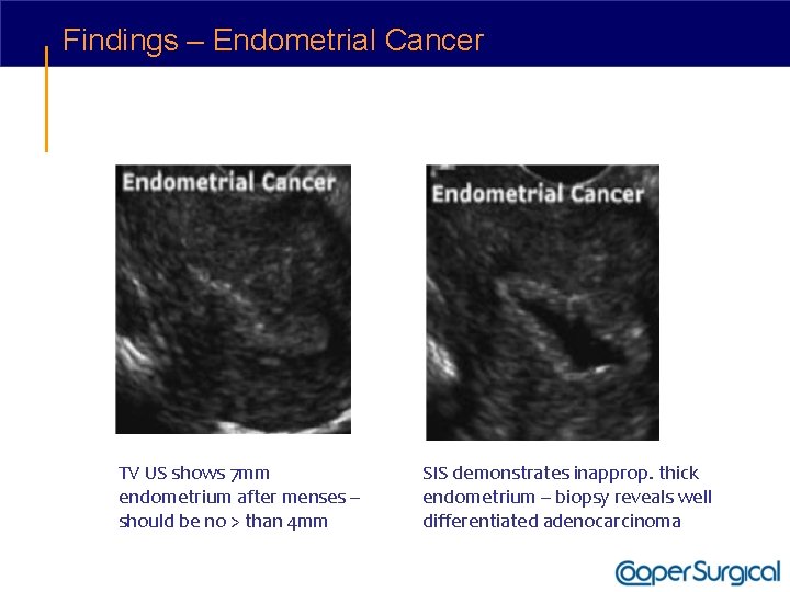Findings – Endometrial Cancer TV US shows 7 mm endometrium after menses – should