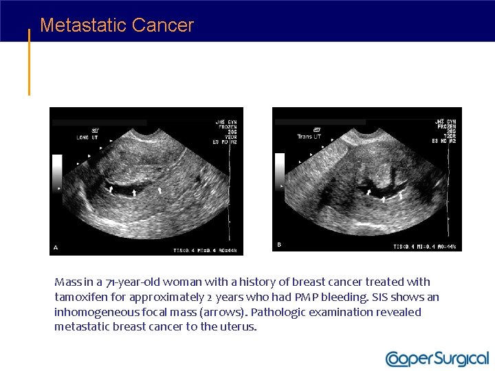 Metastatic Cancer Mass in a 71 -year-old woman with a history of breast cancer