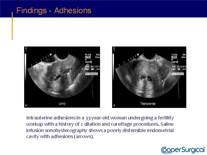 Findings - Adhesions Intrauterine adhesions in a 33 -year-old woman undergoing a fertility workup