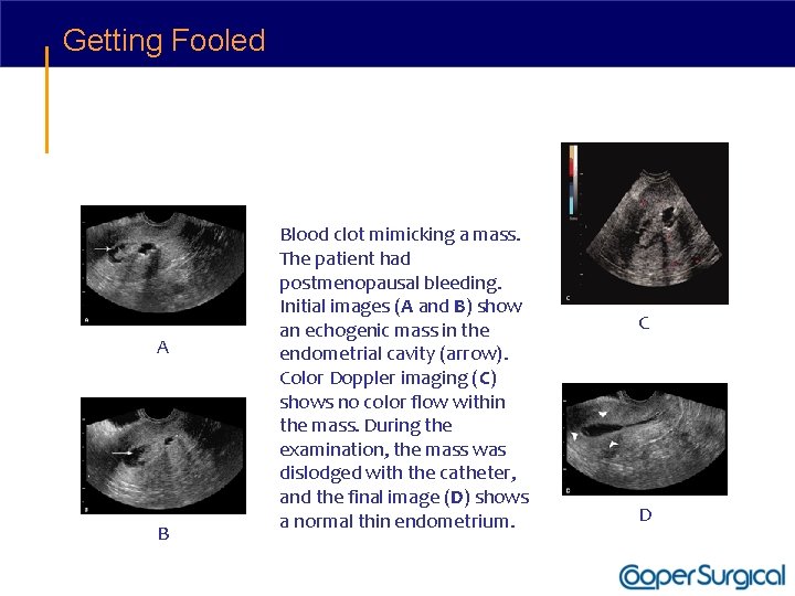 Getting Fooled A B Blood clot mimicking a mass. The patient had postmenopausal bleeding.