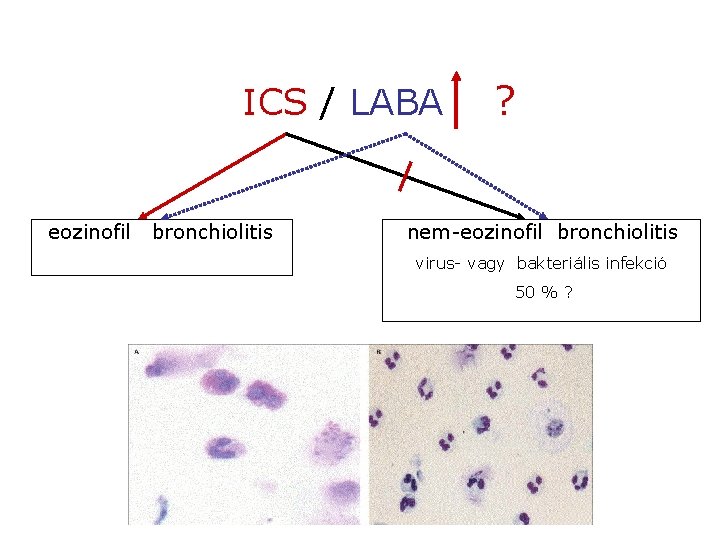 ICS / LABA eozinofil bronchiolitis ? nem-eozinofil bronchiolitis virus- vagy bakteriális infekció 50 %